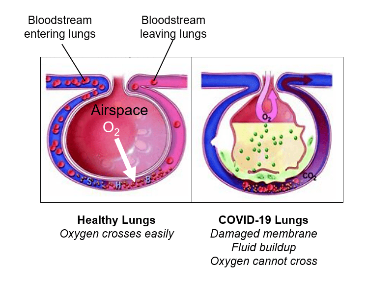 Lung condition in COVID-19