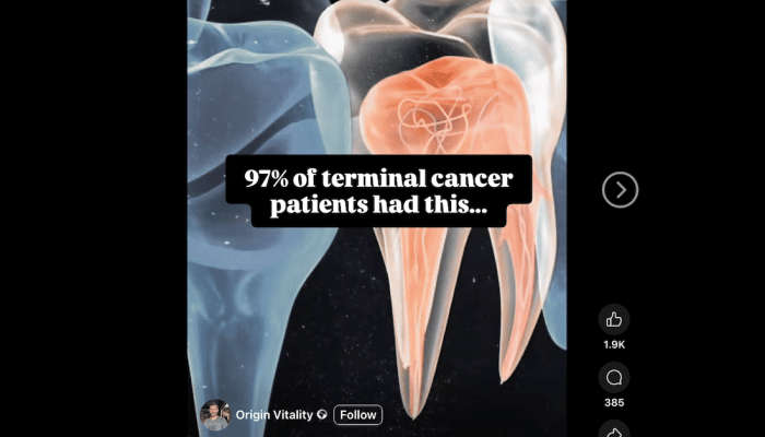 Baseless claims linking root canals with cancer and other serious illnesses rely on outdated and long-disproven theories