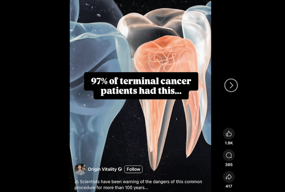 Baseless claims linking root canals with cancer and other serious illnesses rely on outdated and long-disproven theories